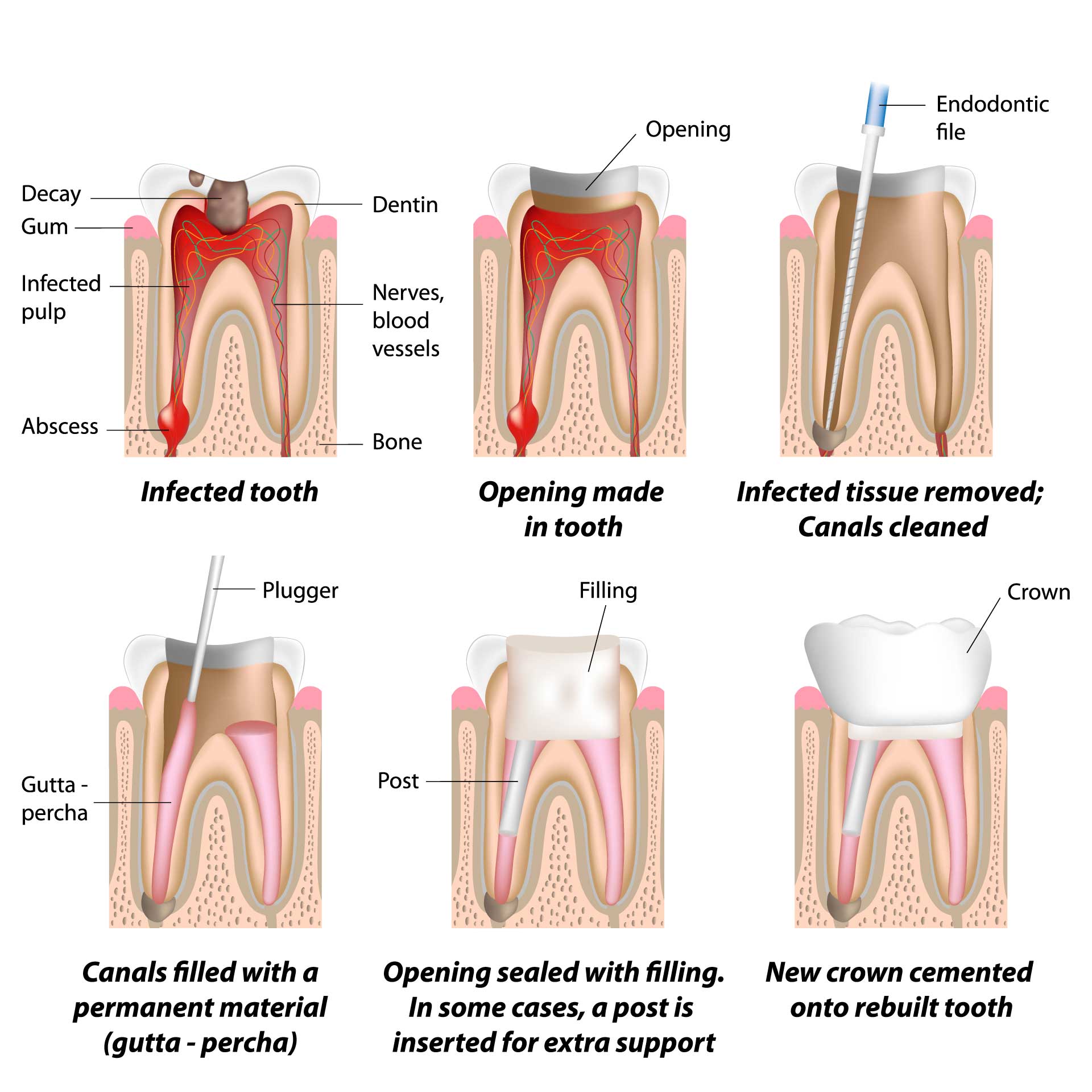 Root canal treatment Chatswood